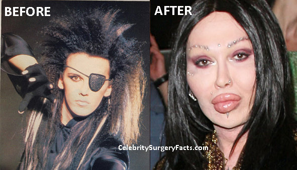 pete-burns-before-and-after